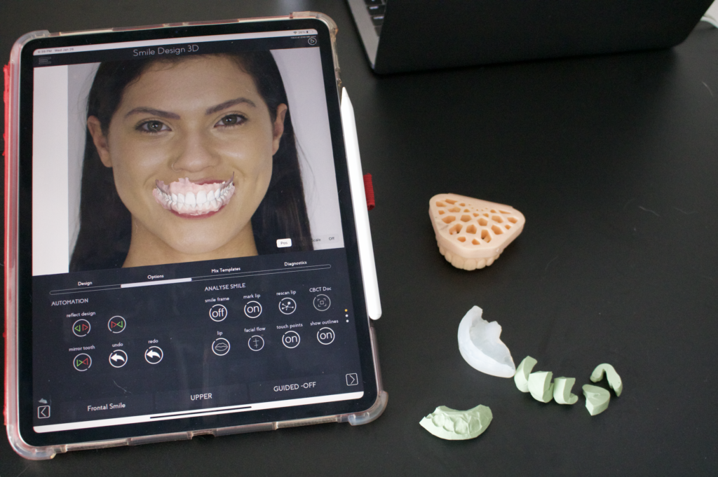 composite veneers smilefy drdiogo alves SmileFy