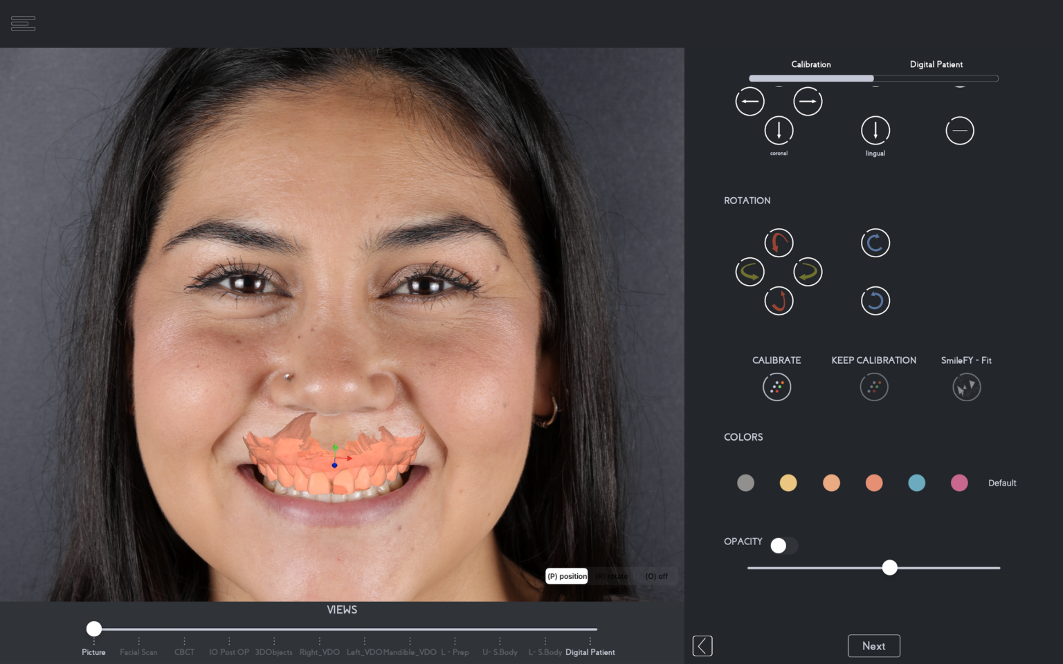 Use of inoffice 3D Smile Design for an OpenMethod Clinical Prep