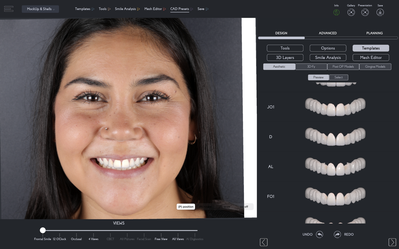 Use of inoffice 3D Smile Design for an OpenMethod Clinical Prep