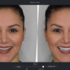 3D SMILE SIMULATION BEFORE AND AFTER