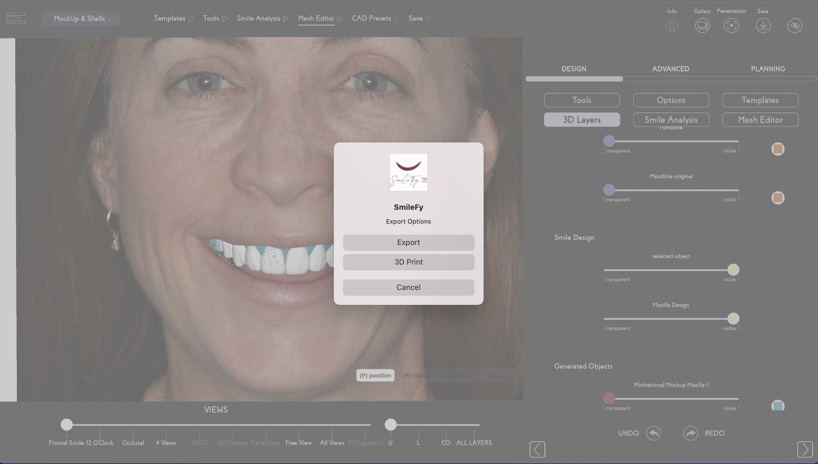 Printed Models + in-mouth Smile Trial:    A silicone key was fabricated to create a mock-up out of bis-acryl resin. The mock-up was placed onto the patient’s teeth, and when shown to her, she expressed how satisfied she was with the aesthetics and natural look of her new smile.