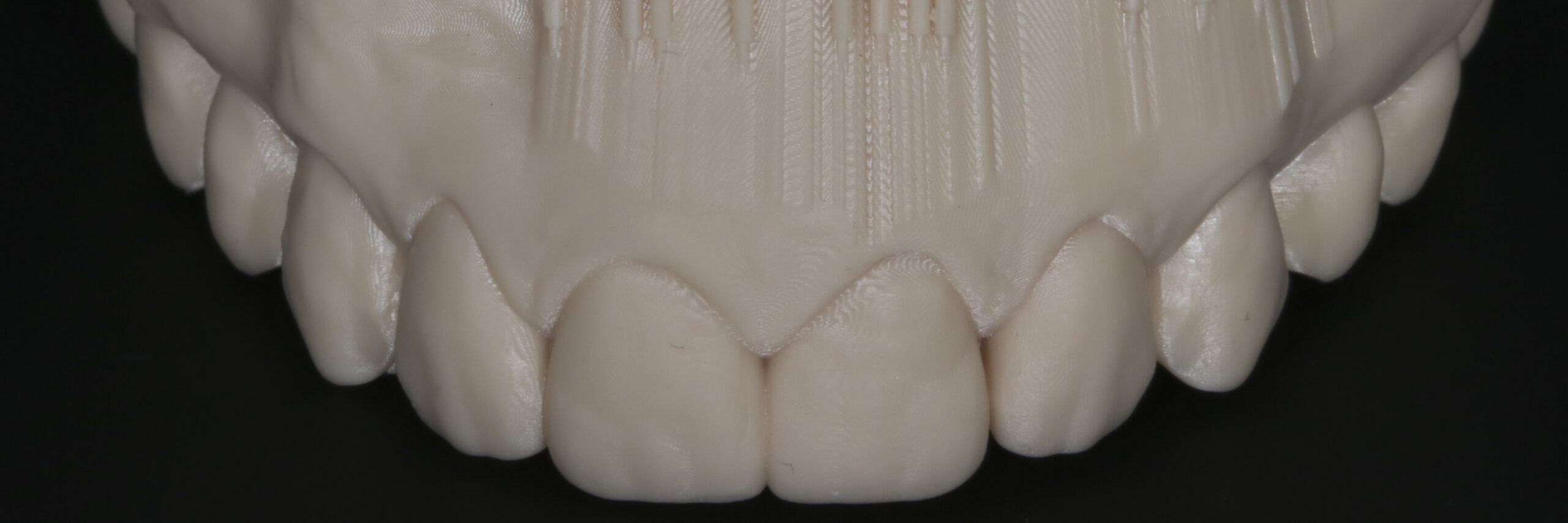 The diagnostic 3D wax-up was used as a guide to place the provisional veneers (Fig. 11).